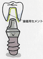 �C���v�����g